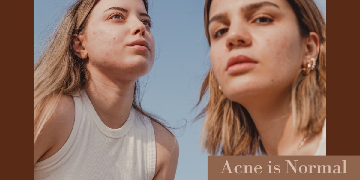 Got Adult Acne? Get Answers from an Expert