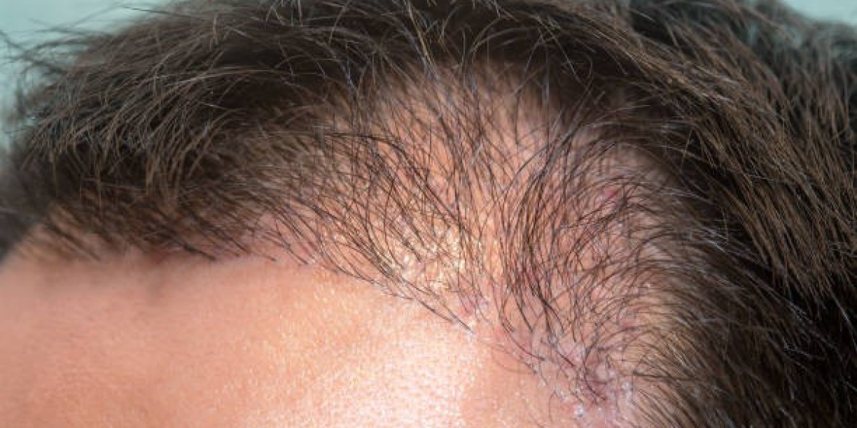 When can hair transplants fail?